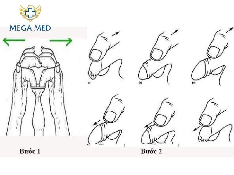 cách lột bao quy đầu tại nhà